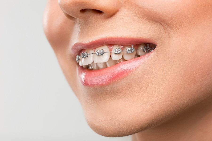 Can Ifill Teeth Spacing Or Do I Need Braces? Exploring Your Options